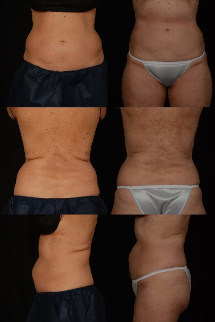 , CoolSculpting Before and After