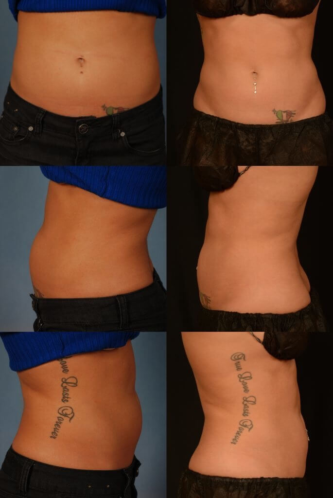 , CoolSculpting Before and After
