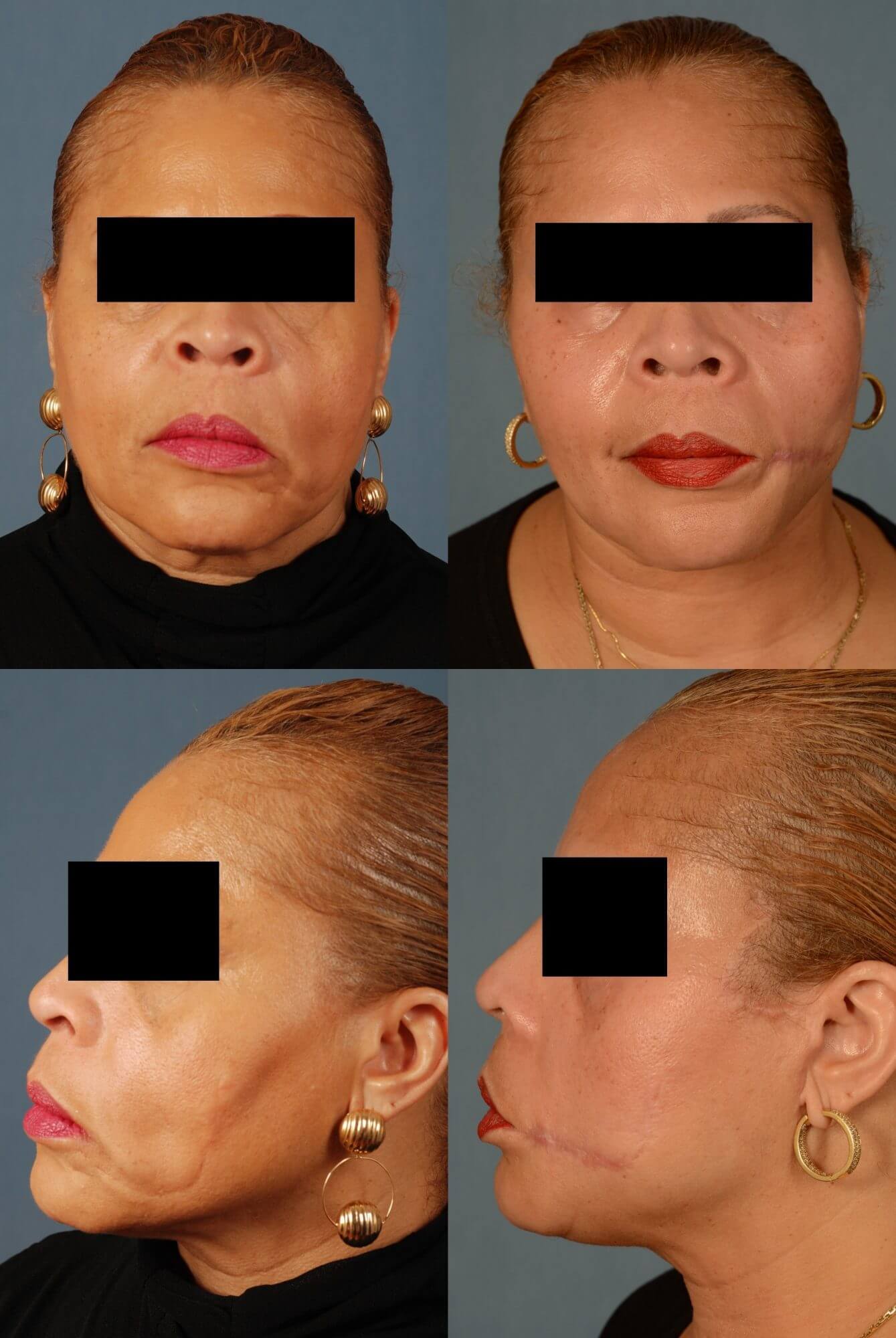, Facial Reconstruction