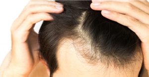 PRP for Alopecia